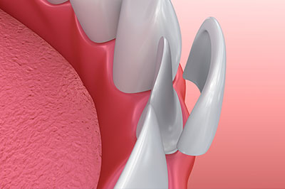 The image shows a close-up of a dental implant with a metallic screw and a pink gum background.